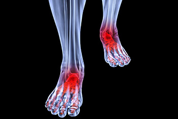 Arthritic foot and ankle care treatment, foot arthritis treatment in the Salisbury, NC 28144; Charlotte, NC 28215; Concord, NC 28025 areas