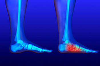 Flat feet and Fallen Arches treatment, Flatfoot Deformity Treatment in the Salisbury, NC 28144; Charlotte, NC 28215; Concord, NC 28025 areas