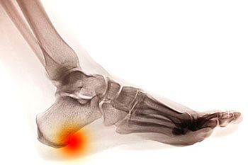 Heel spurs treatment in the Salisbury, NC 28144; Charlotte, NC 28215; Concord, NC 28025 areas