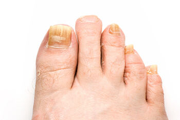 Fungal toenails diagnosis and treatment in the Salisbury, NC 28144; Charlotte, NC 28215; Concord, NC 28025 areas