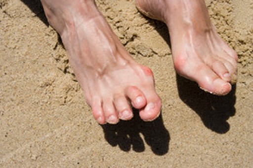 What Are Hammertoes?