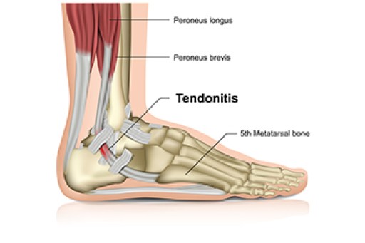 Definition and Causes of Achilles Tendon Injuries