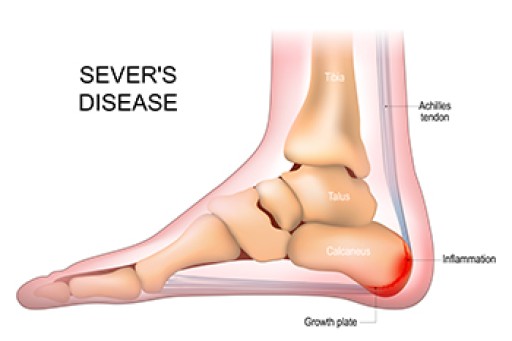 Causes and Treatment Options for Sever’s Disease