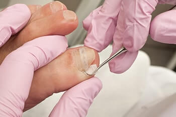 Ingrown toenails treatment in the Salisbury, NC 28144; Charlotte, NC 28215; Concord, NC 28025 areas